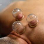 Kurs Terapia bańkami