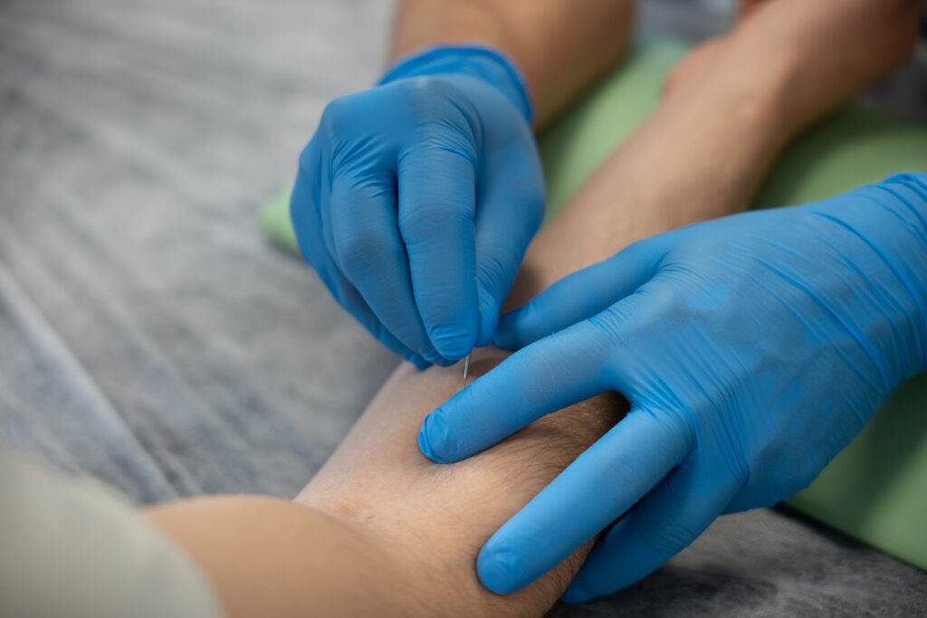 Igłowanie przedramienia