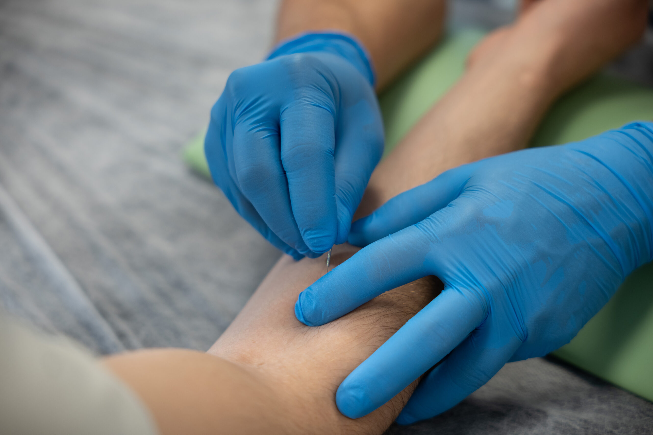 Igłowanie przedramienia